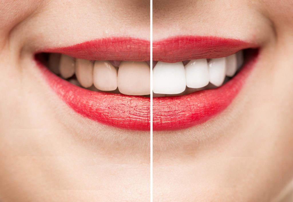 Excellent Tips For Bright Whitening Teeth